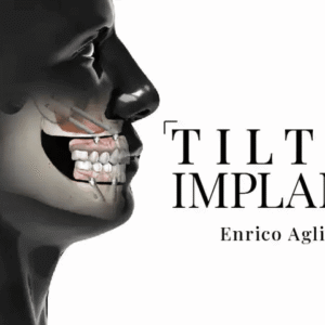 ygomatic and Tilted Implants: Avoiding Bone Grafts with Angulated Solutions