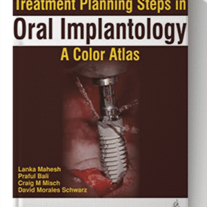 Treatment Planning Steps in Oral Implantology: A Color Atlas